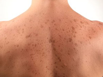 prp skin disease #10