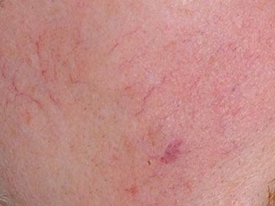 vascular skin lesions