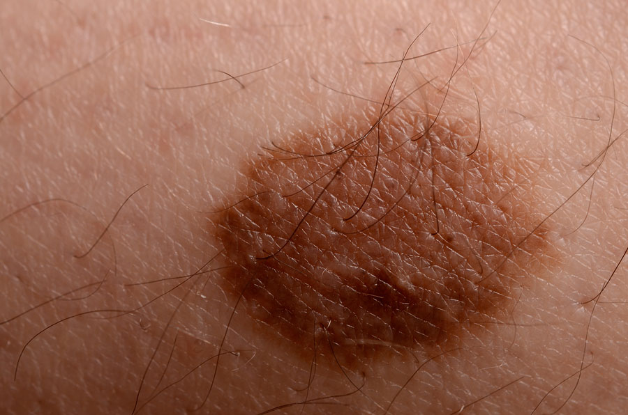 how-to-remove-moles-quickly-skin-moles-mole-removal