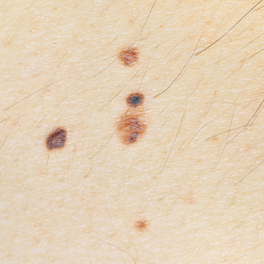 Removing Moles At Home Can Be Dangerous Mayoral Dermatology