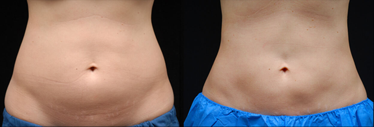 CoolSculpting Before & After Photo Gallery