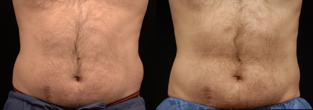 CoolSculpting Before and After Photos by Mayoral Dermatology