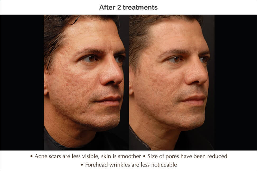 Before And After - Mayoral Dermatology