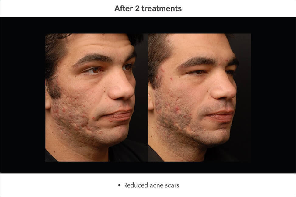 Fractional RF for Scars - Mayoral Dermatology