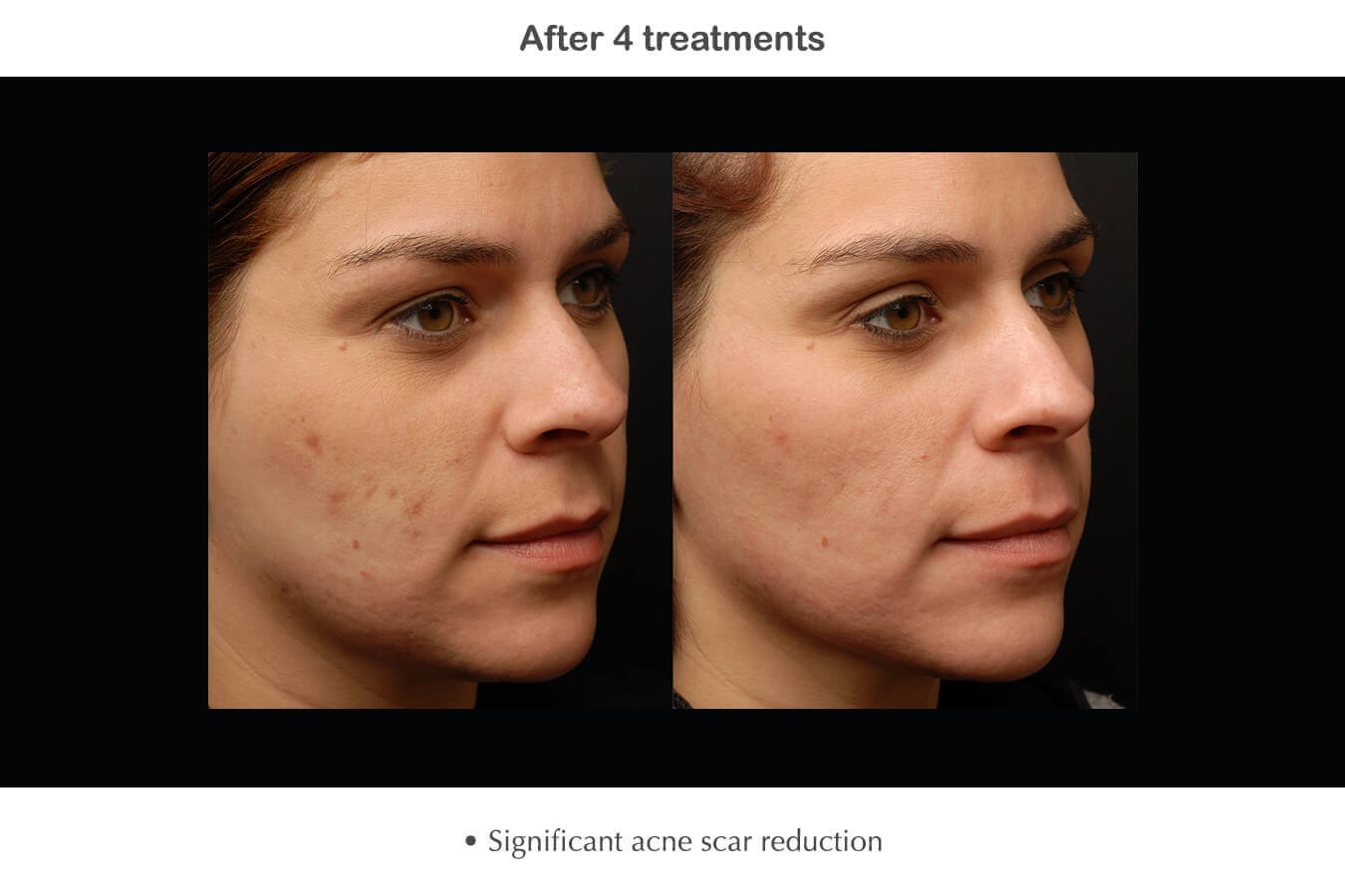 Fractional RF for Acne - Mayoral Dermatology